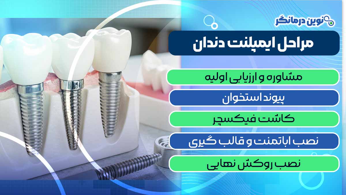 مراحل ایمپلنت دندان