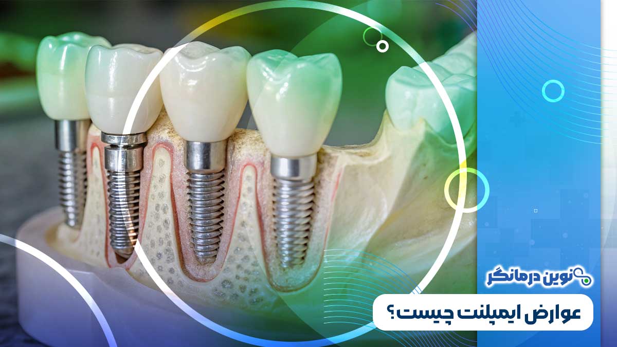 عوارض ایمپلنت چیست؟