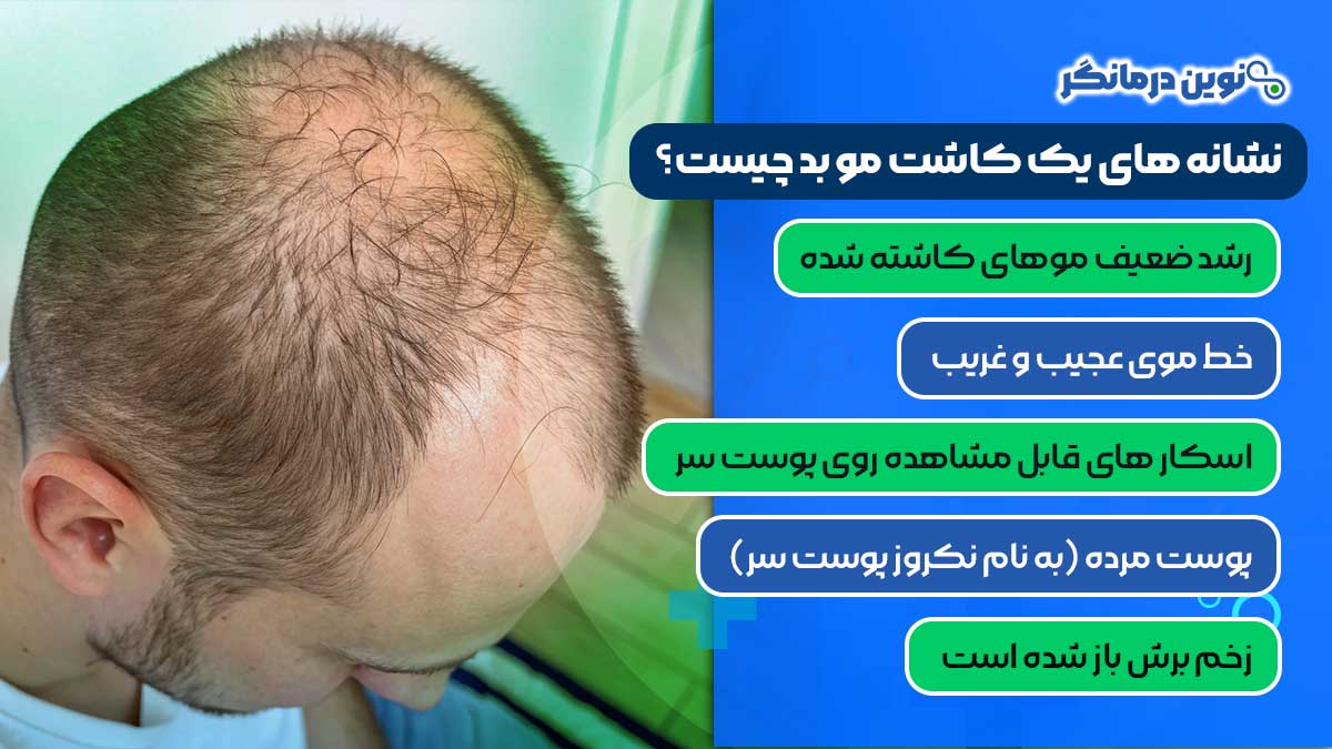 نشانه های یک کاشت مو بد چیست؟