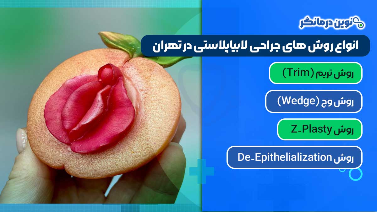 انواع روش های جراحی لابیاپلاستی در تهران
