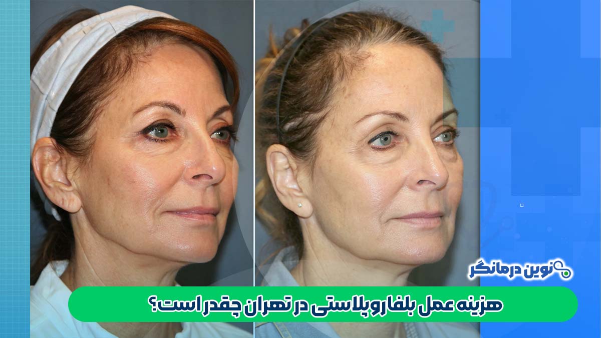 هزینه عمل بلفاروپلاستی در تهران چقدر است؟