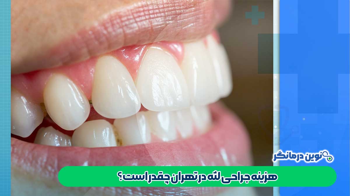 هزینه جراحی لثه در تهران چقدر است؟