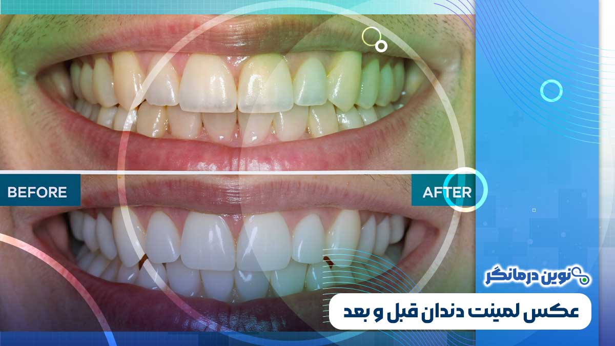 تفاوت لمینت و کامپوزیت چیست؟