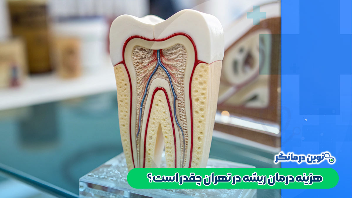 هزینه درمان ریشه در تهران چقدر است؟