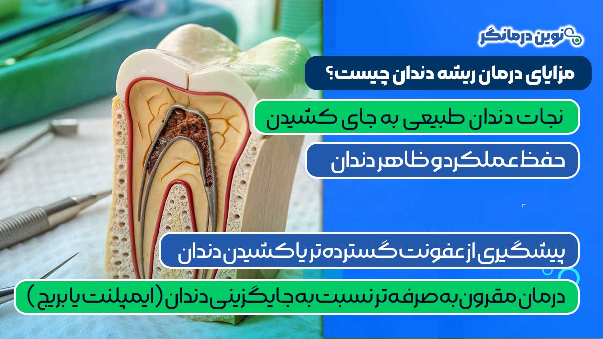 مزایای درمان ریشه دندان چیست؟