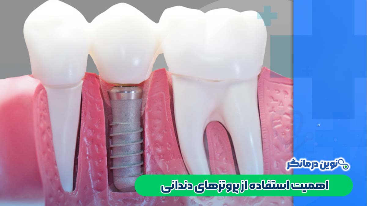 اهمیت استفاده از پروتزهای دندانی چیست؟