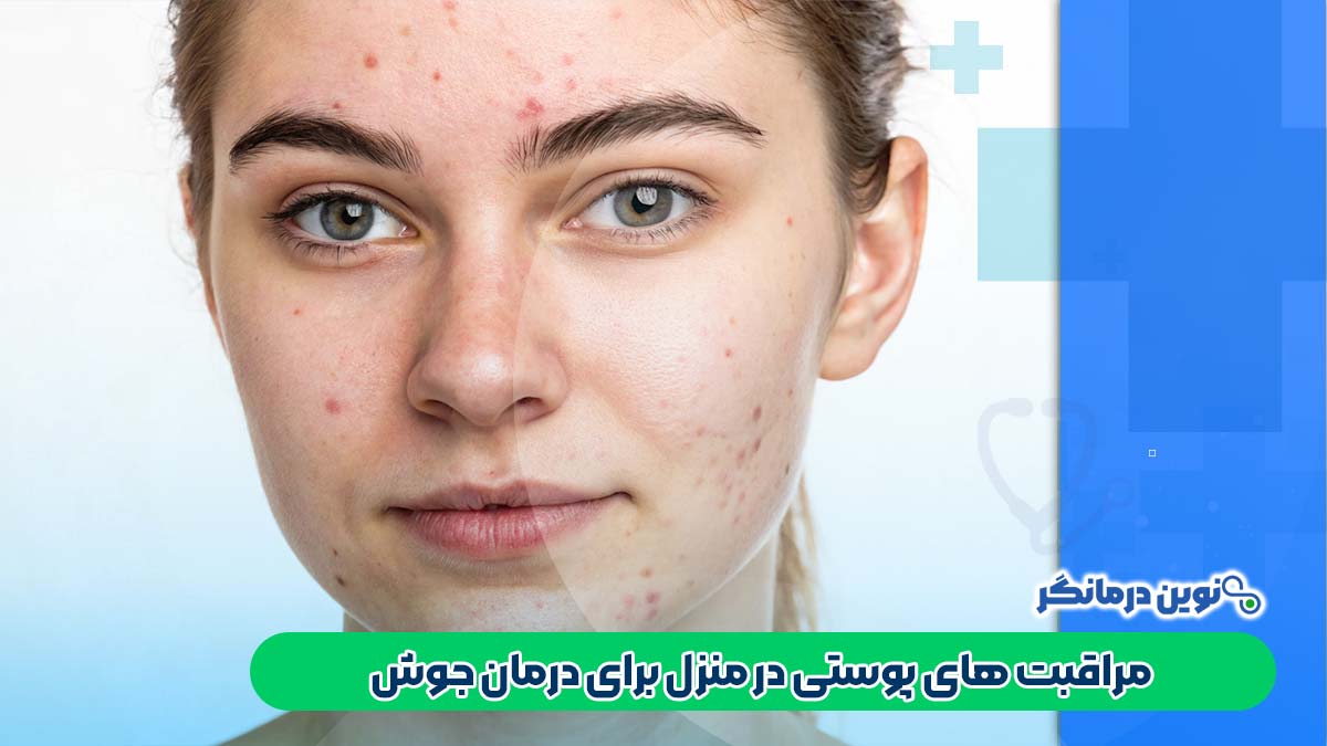 مراقبت‌ های پوستی در منزل برای درمان جوش
