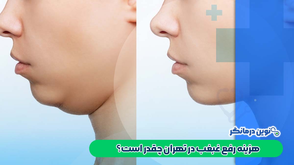 هزینه رفع غبغب در تهران چقدر است؟