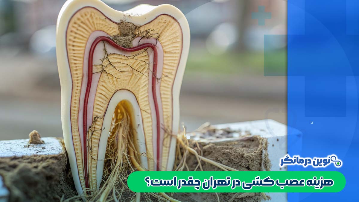 هزینه عصب کشی در تهران چقدر است؟