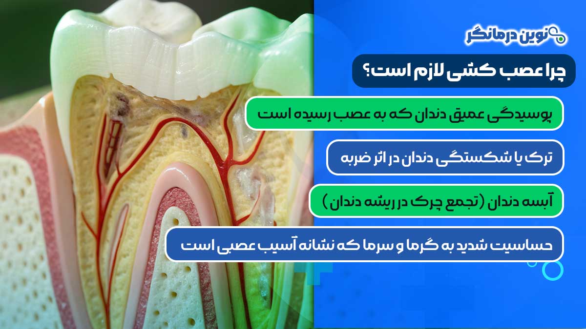 چرا عصب کشی لازم است؟