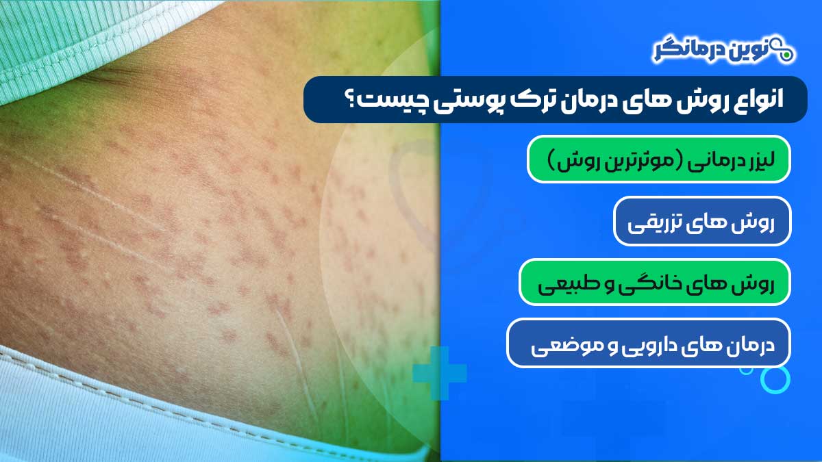 انواع روش های درمان ترک پوستی چیست؟