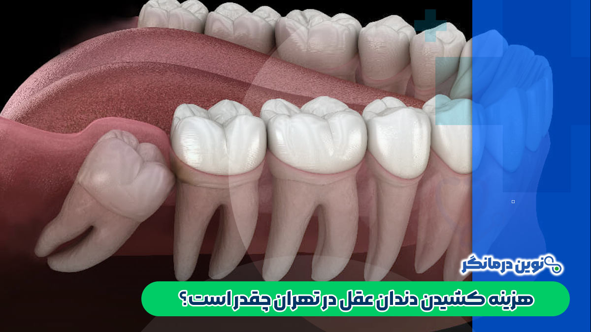 هزینه کشیدن دندان عقل در تهران چقدر است؟