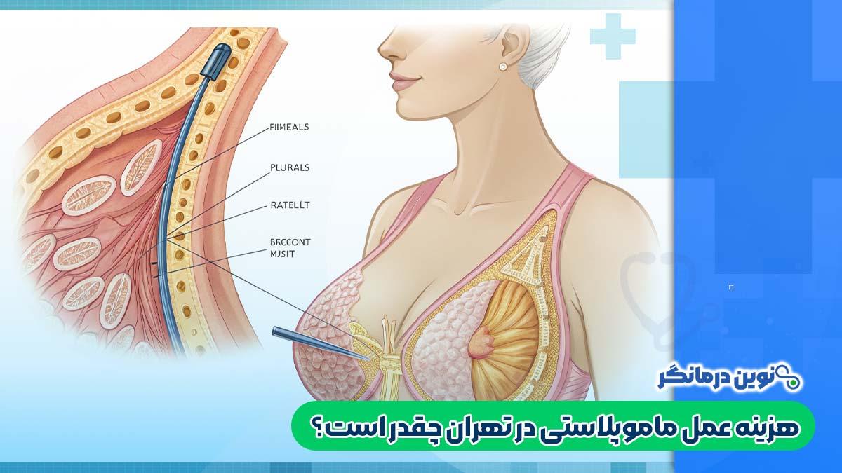 هزینه عمل ماموپلاستی در تهران چقدر است؟