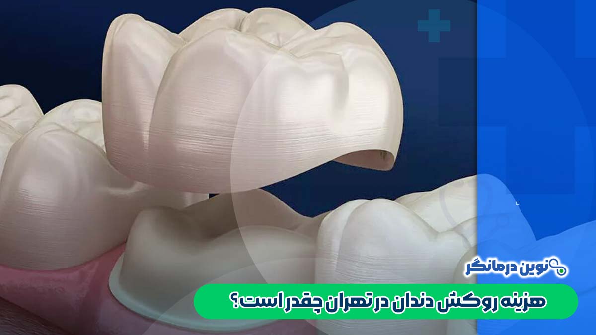 هزینه روکش دندان در تهران چقدر است؟
