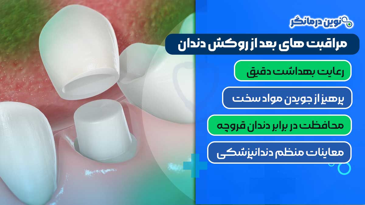 مراقبت های بعد از روکش دندان