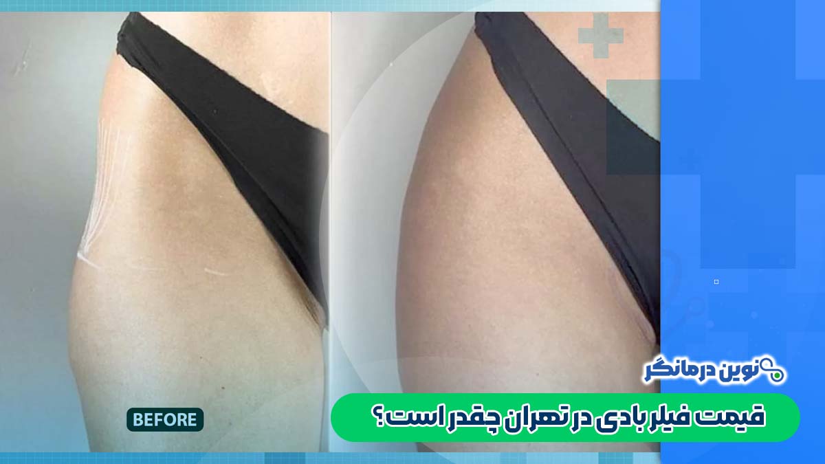 قیمت فیلر بادی در تهران چقدر است؟
