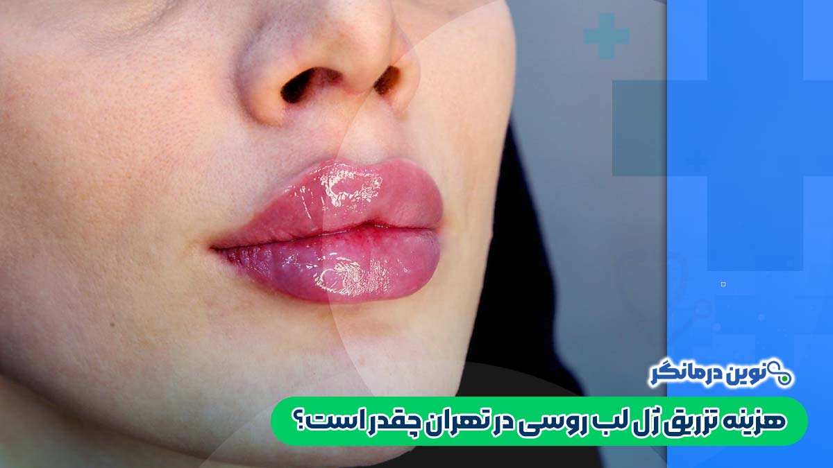 هزینه تزریق ژل لب روسی در تهران چقدر است؟