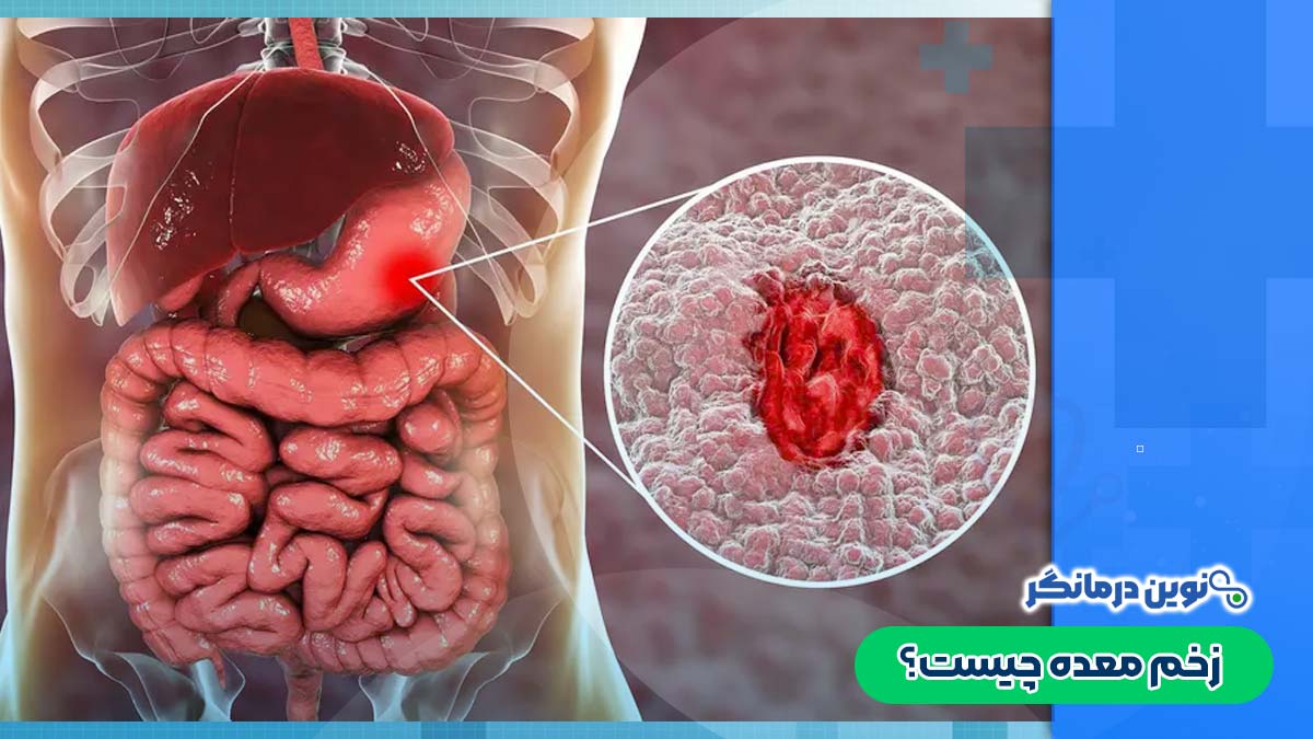 زخم معده چیست؟