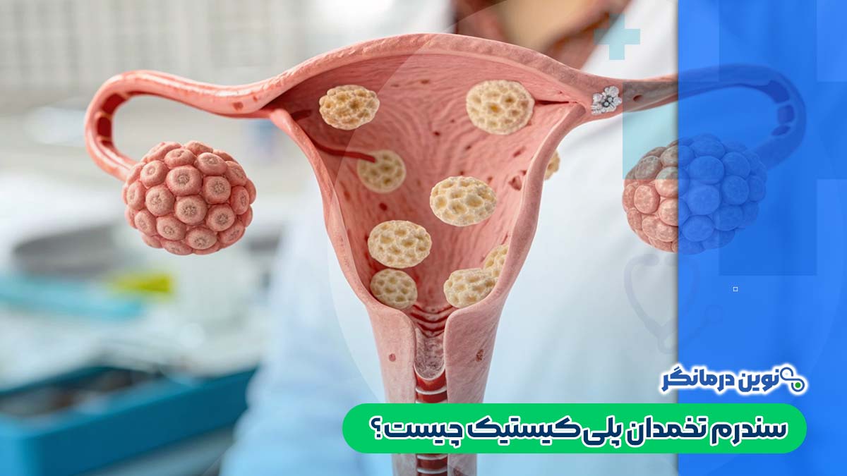سندرم تخمدان پلی‌کیستیک چیست؟