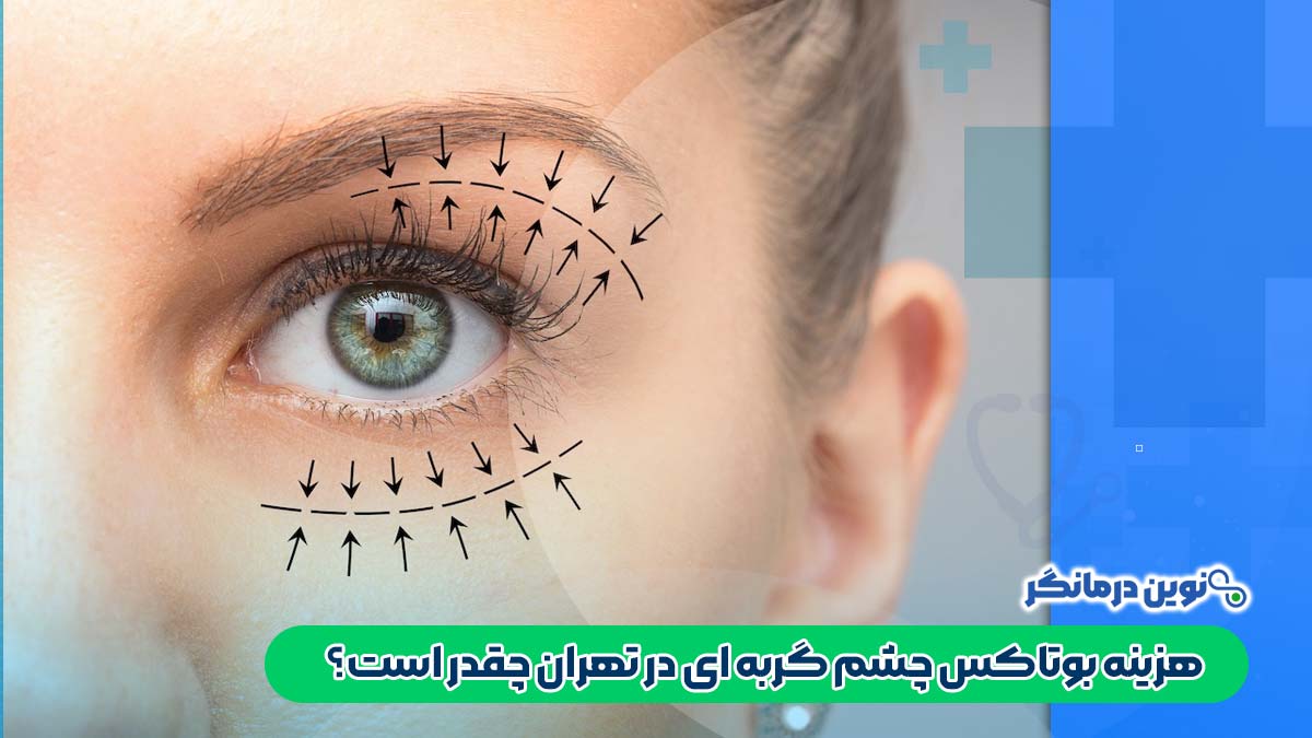 هزینه بوتاکس چشم گربه ای در تهران چقدر است؟