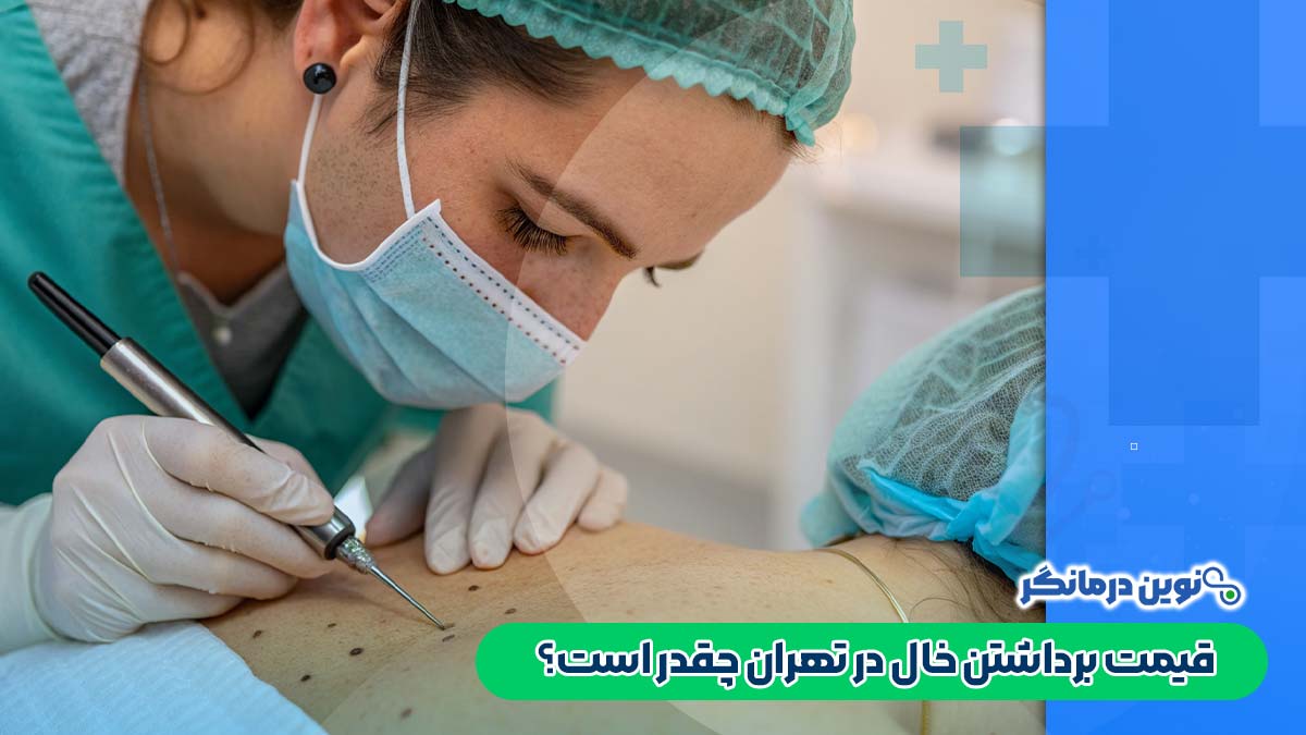 قیمت برداشتن خال در تهران چقدر است؟
