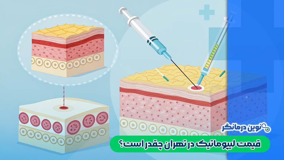 قیمت لیپوماتیک در تهران چقدر است؟