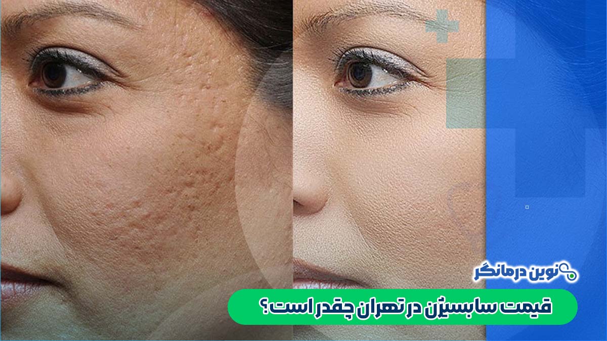 قیمت سابسیژن در تهران چقدر است؟