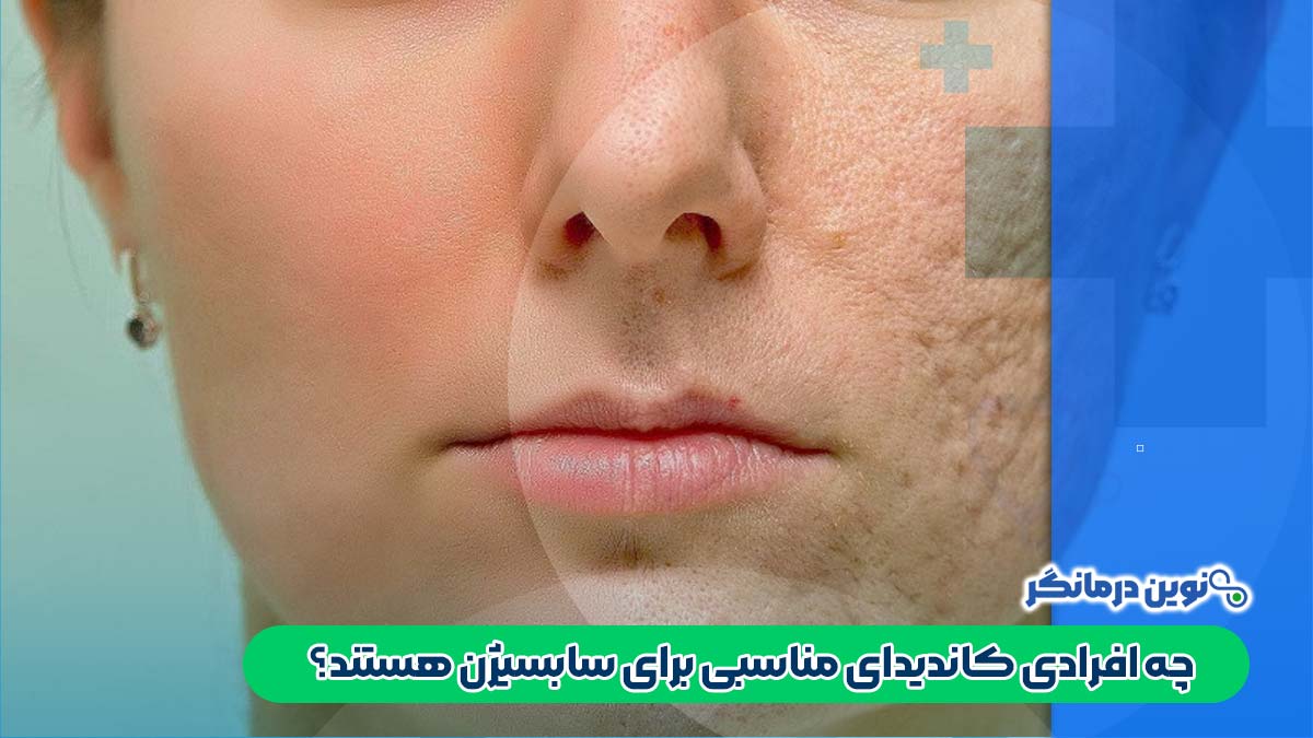 چه افرادی کاندیدای مناسبی برای سابسیژن هستند؟