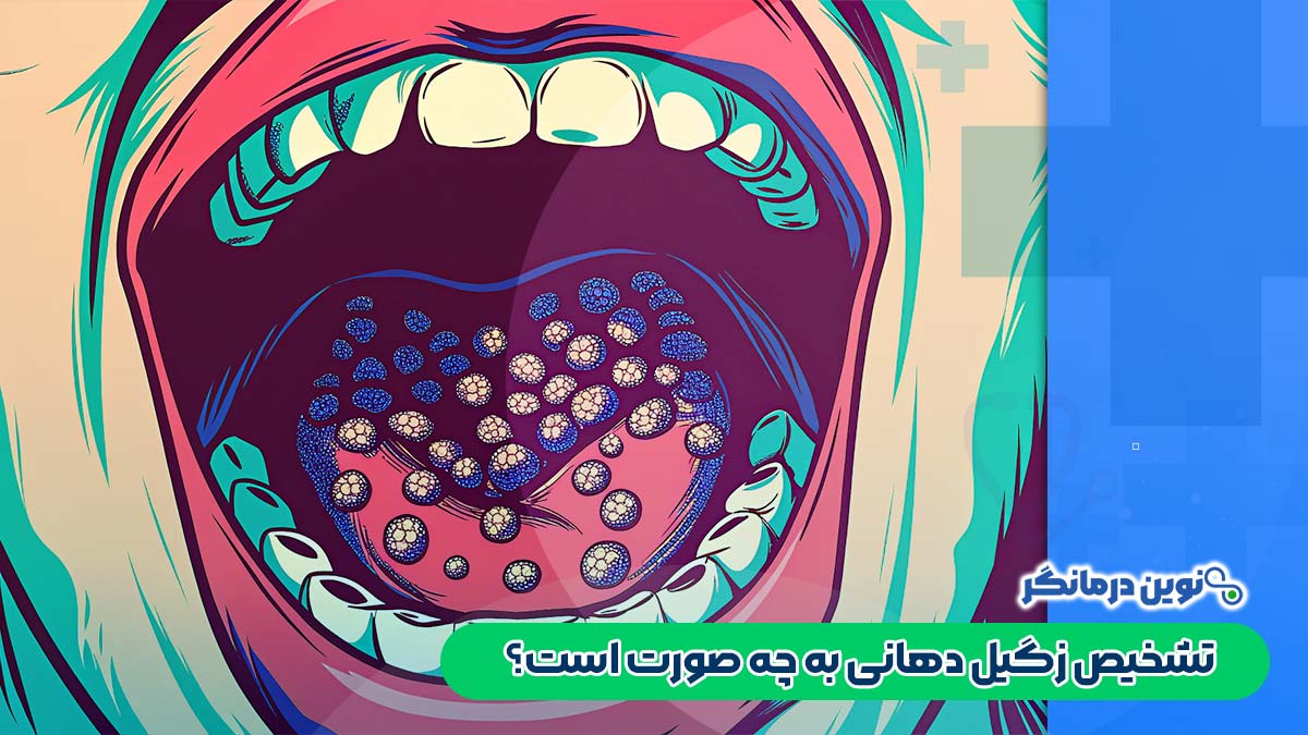 تشخیص زگیل دهانی به چه صورت است؟