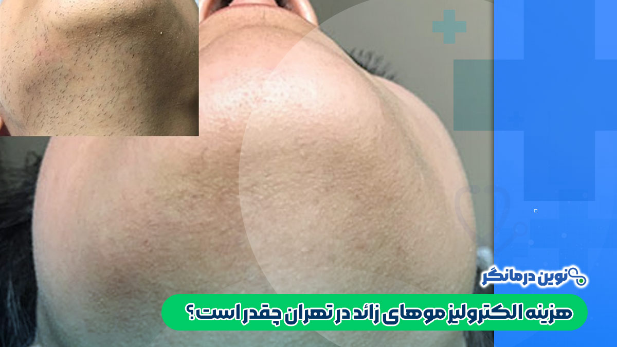 هزینه الکترولیز موهای زائد در تهران چقدر است؟