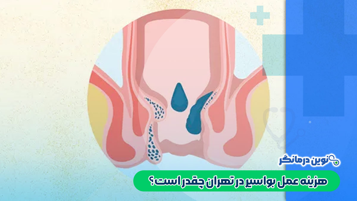 هزینه عمل بواسیر در تهران چقدر است؟