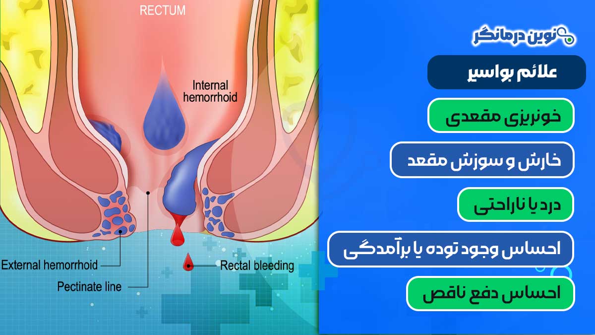 علائم بواسیر