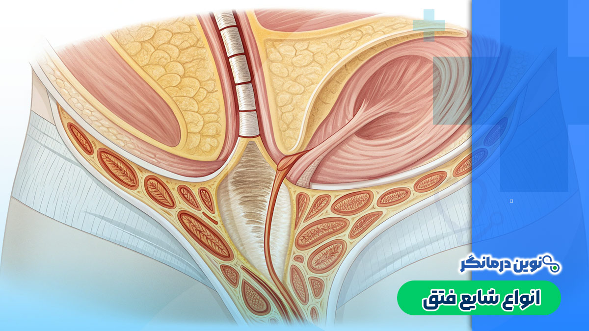 انواع شایع فتق