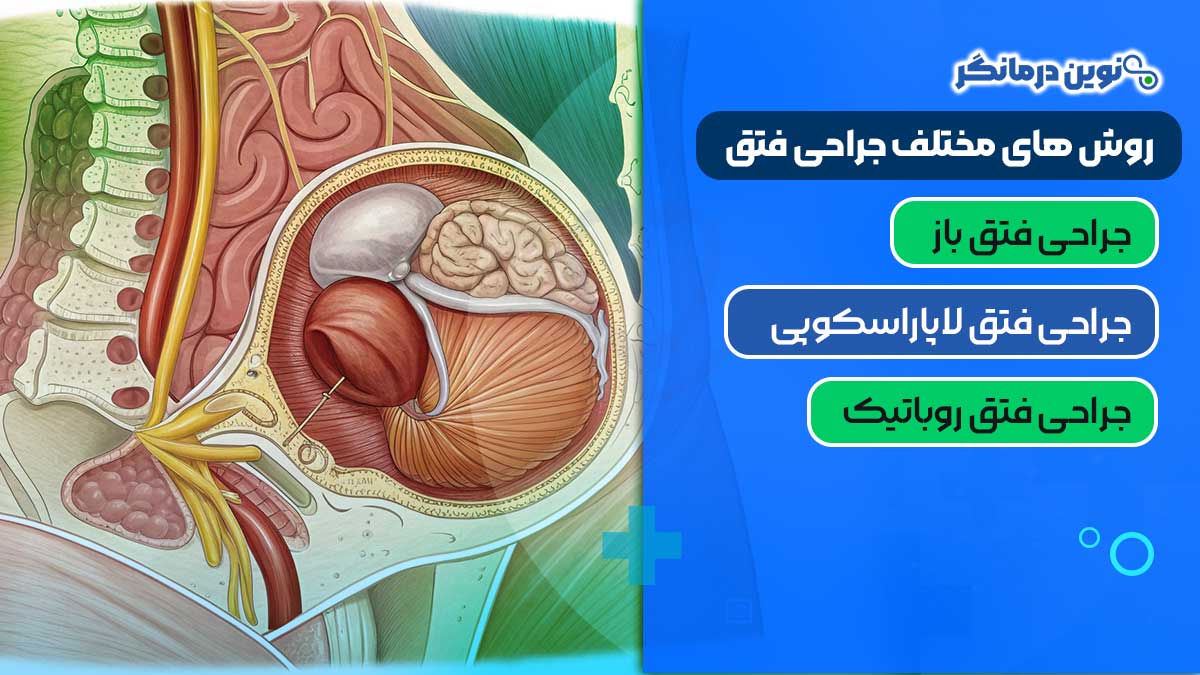 روش های مختلف جراحی فتق