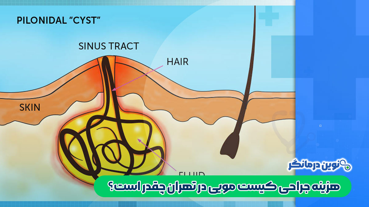 هزینه جراحی کیست مویی در تهران چقدر است؟