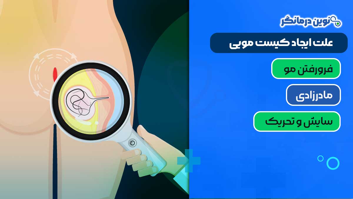 کیست مویی چیست؟