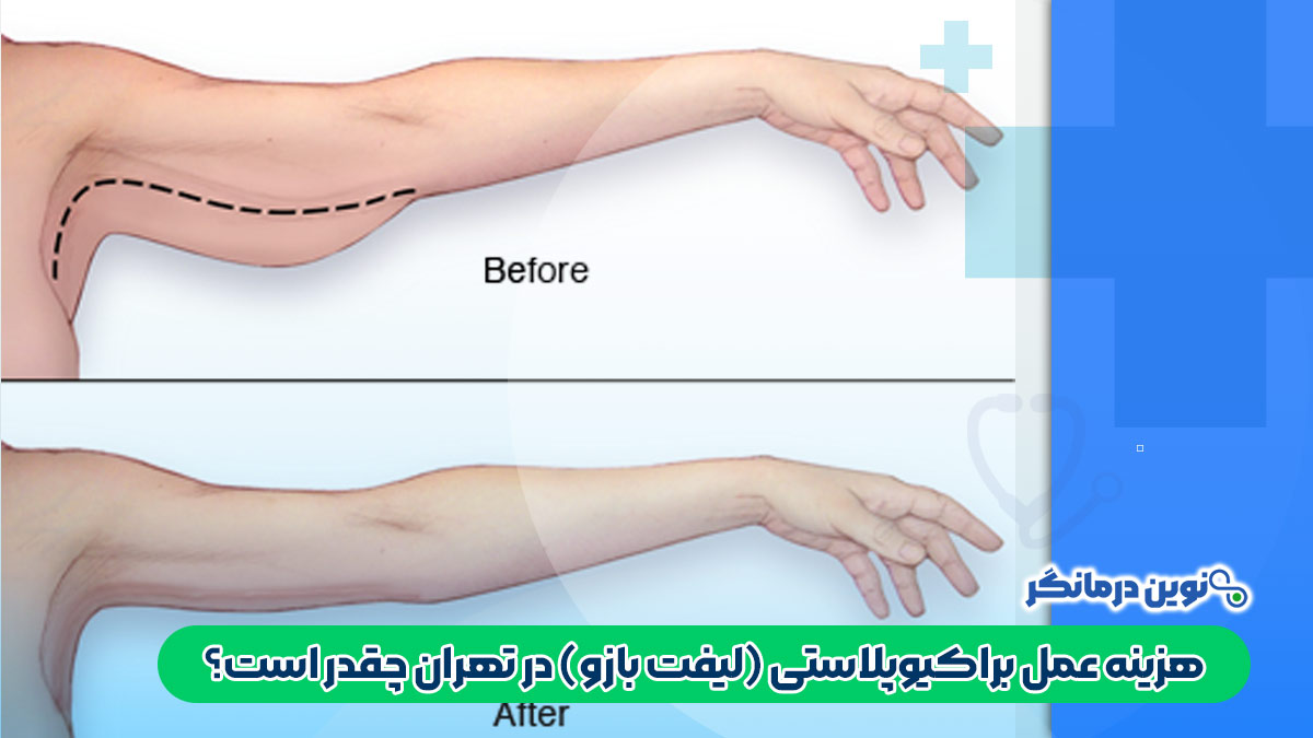 هزینه عمل براکیوپلاستی (لیفت بازو) در تهران چقدر است؟