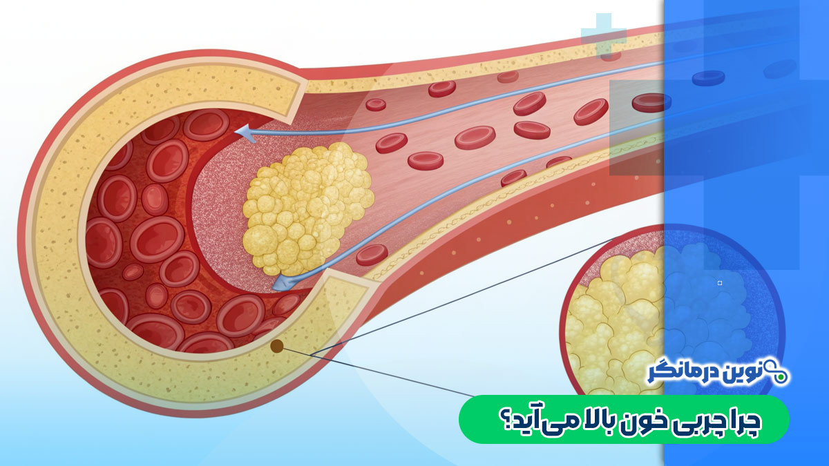 چرا چربی خون بالا می‌آید؟