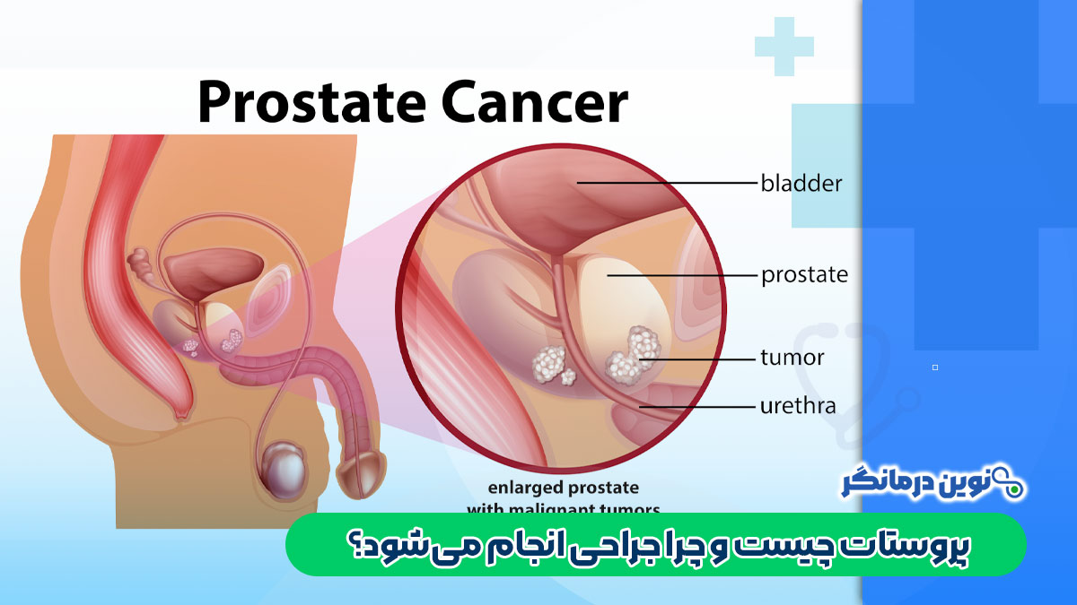 پروستات چیست و چرا جراحی انجام میشود؟
