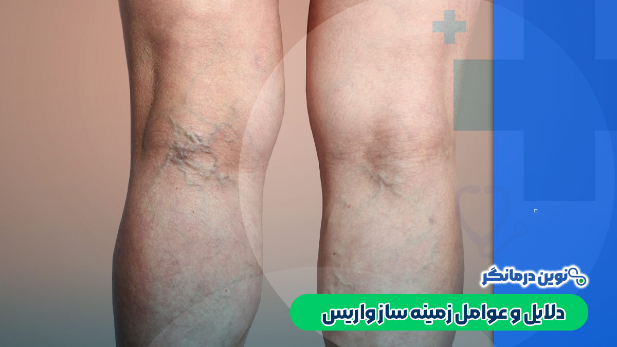 دلایل و عوامل زمینه‌ ساز واریس