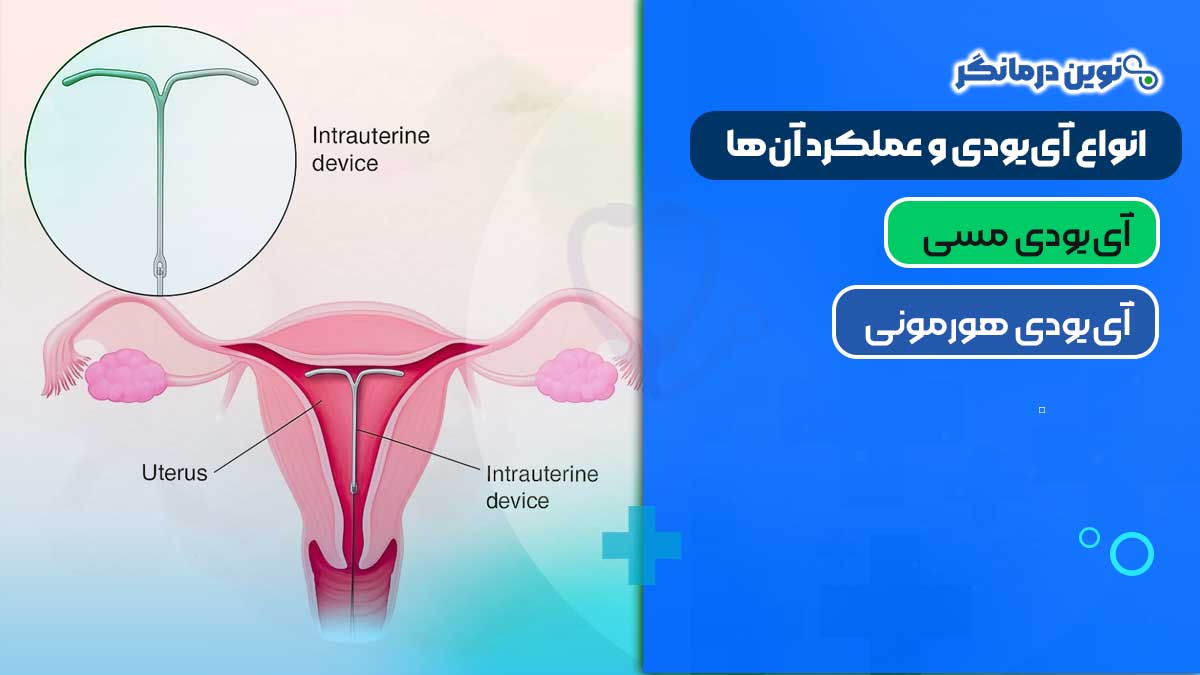 انواع آی‌یو‌دی و عملکرد آن‌ها