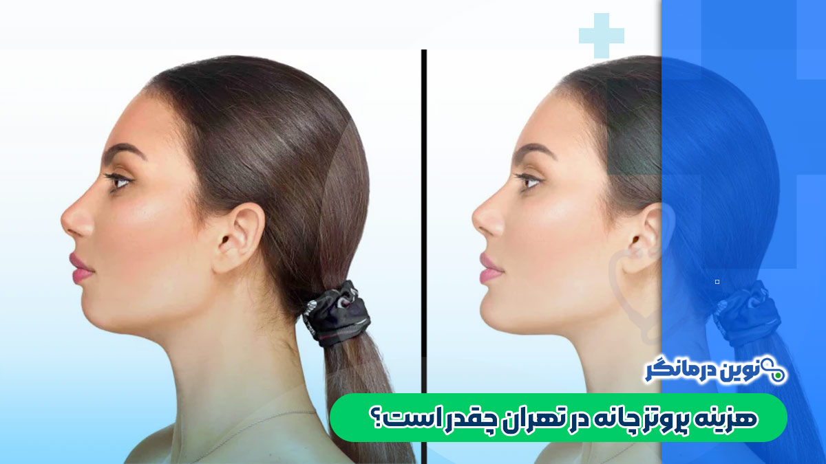 هزینه پروتز چانه در تهران چقدر است؟