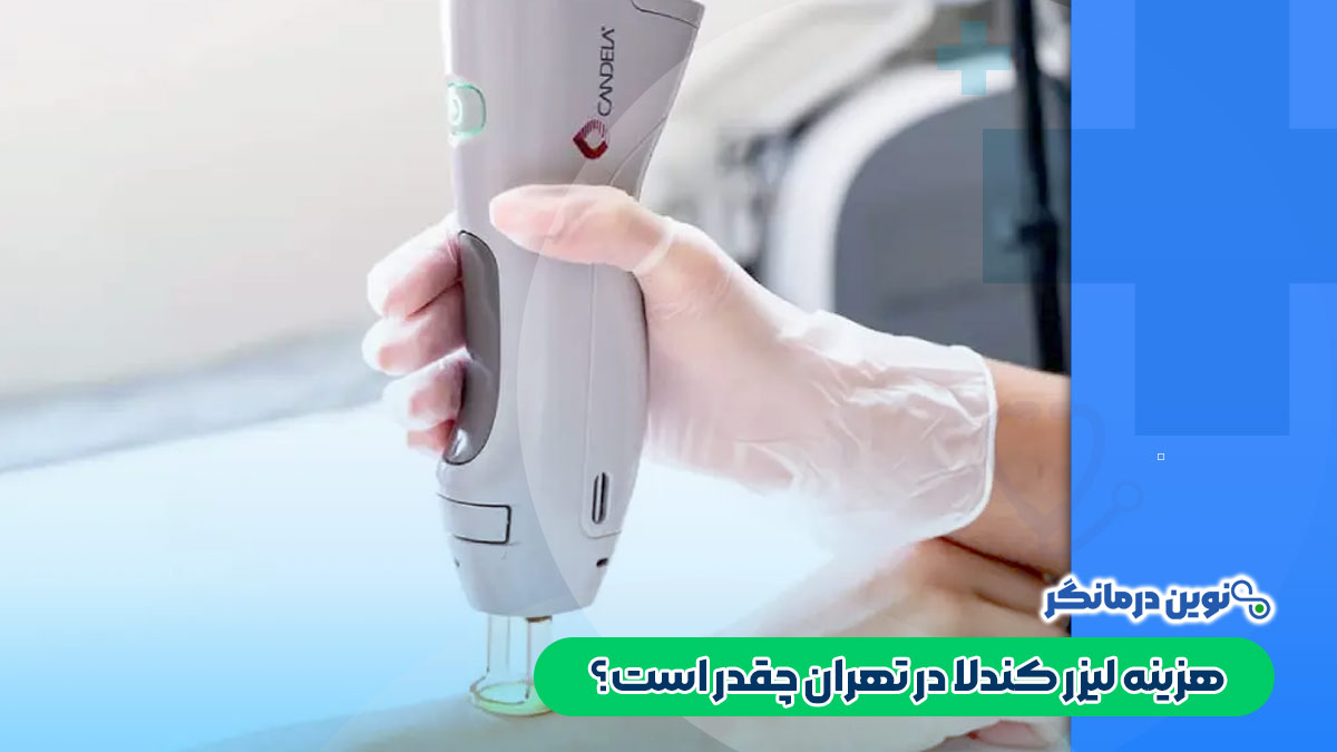 هزینه لیزر کندلا در تهران چقدر است؟