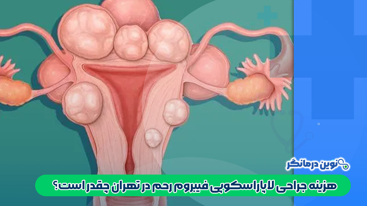 هزینه جراحی لاپاراسکوپی فیبروم رحم در تهران چقدر است؟