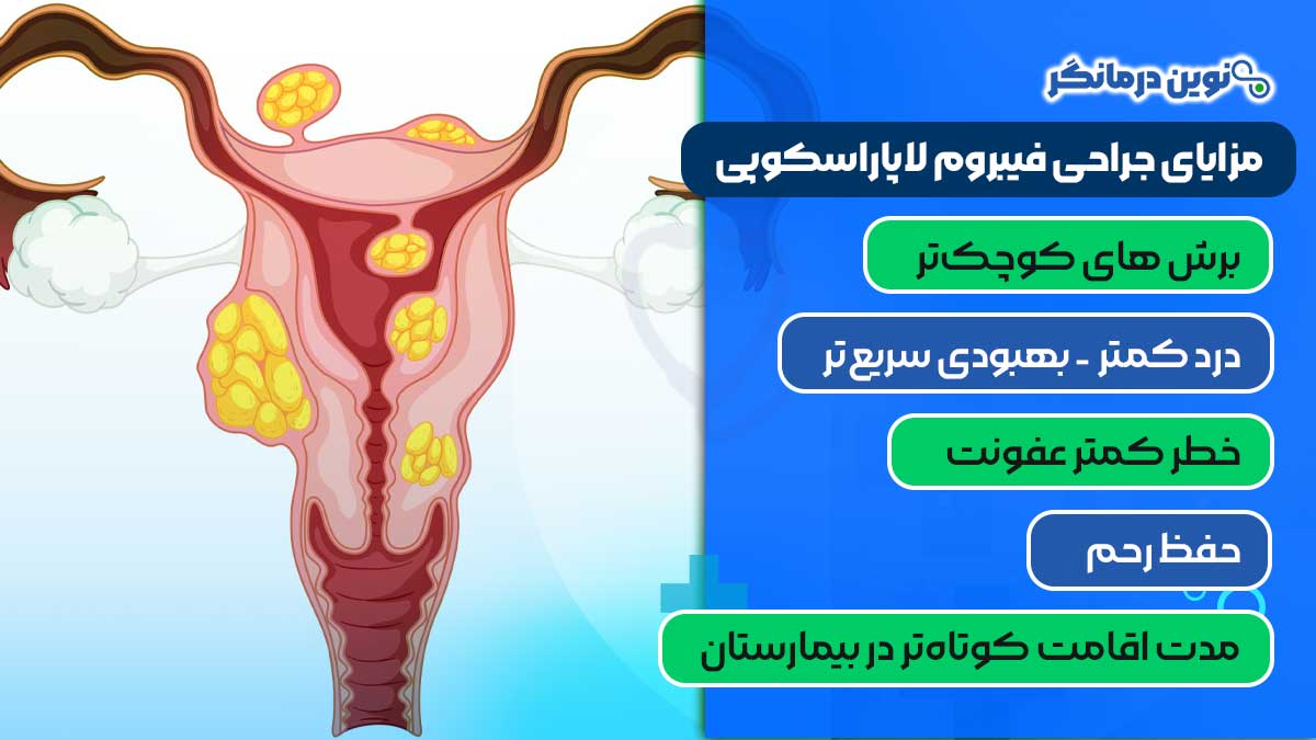 مزایای جراحی فیبروم لاپاراسکوپی