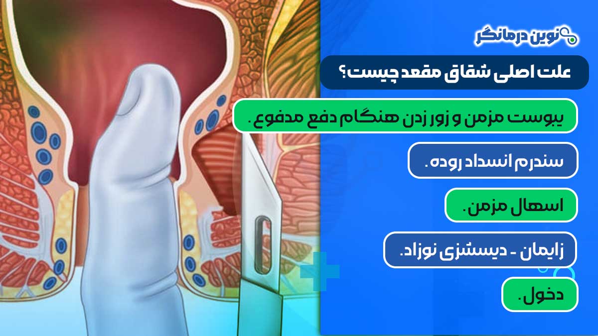 علت اصلی شقاق مقعد چیست؟