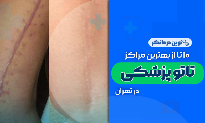 10 تا از بهترین مراکز تاتو پزشکی در تهران