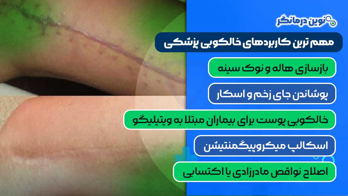 مهم ترین کاربردهای خالکوبی پزشکی