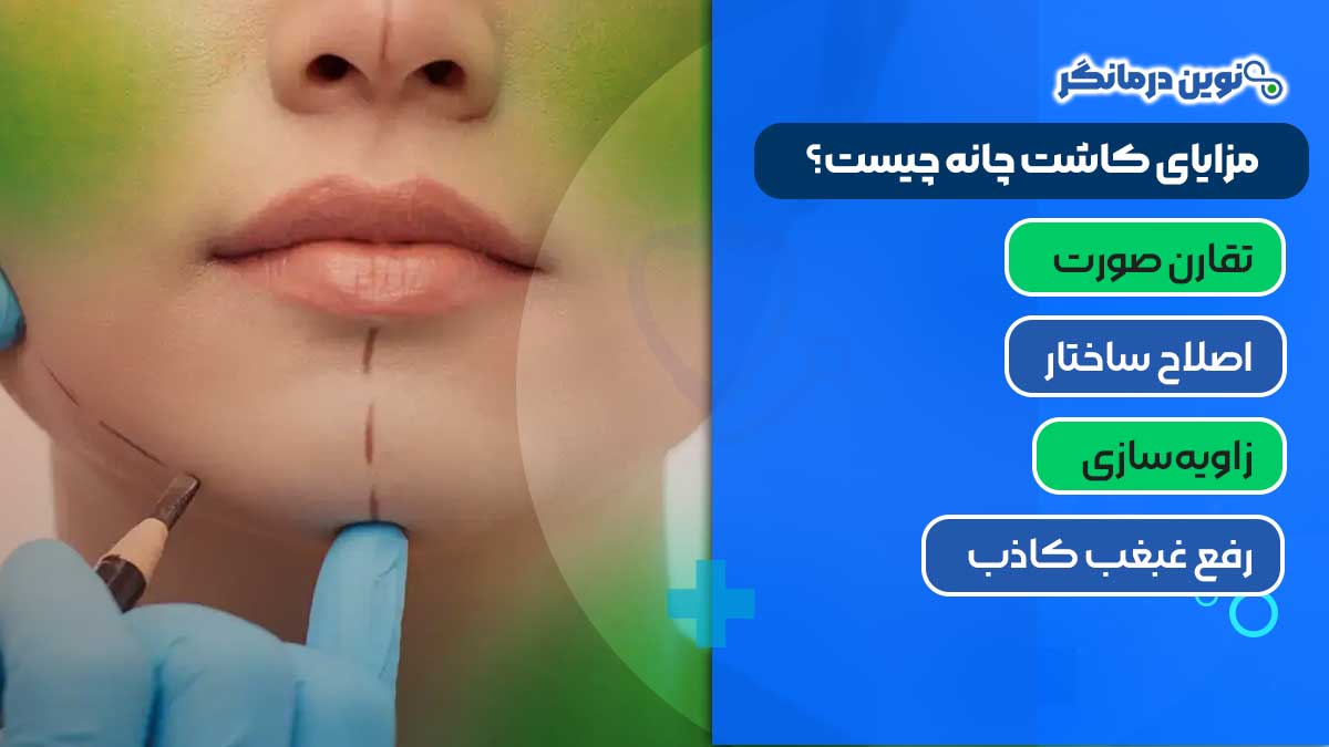 مزایای کاشت چانه چیست؟