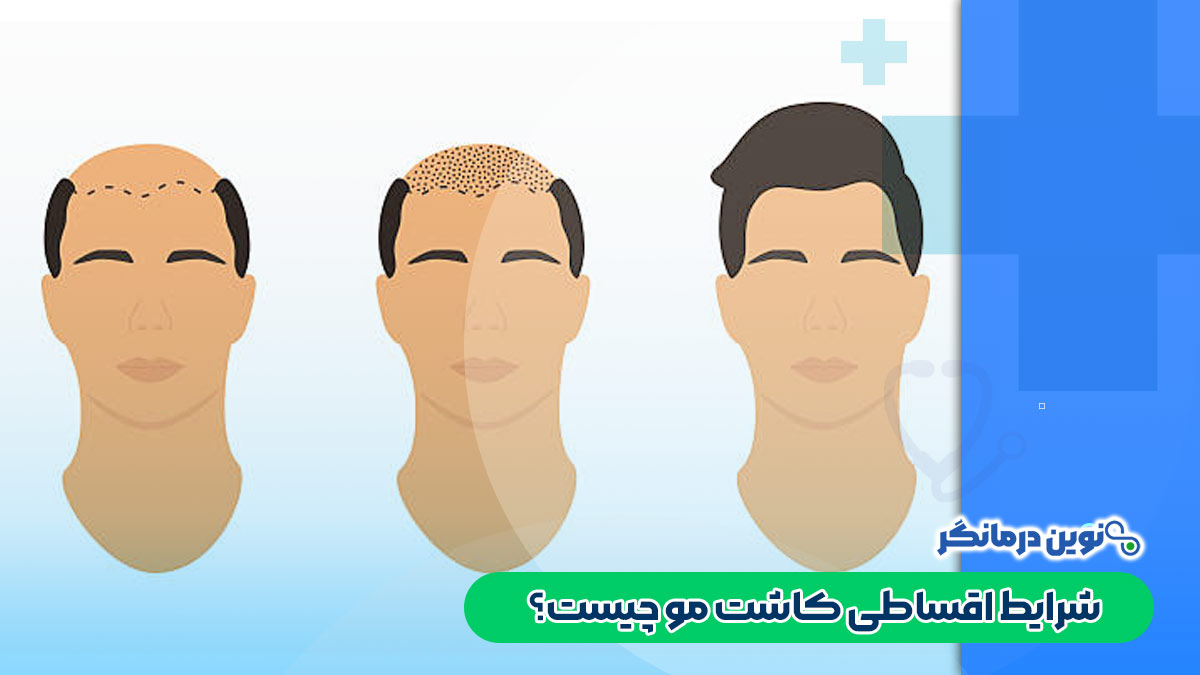 شرایط اقساطی کاشت مو چیست؟